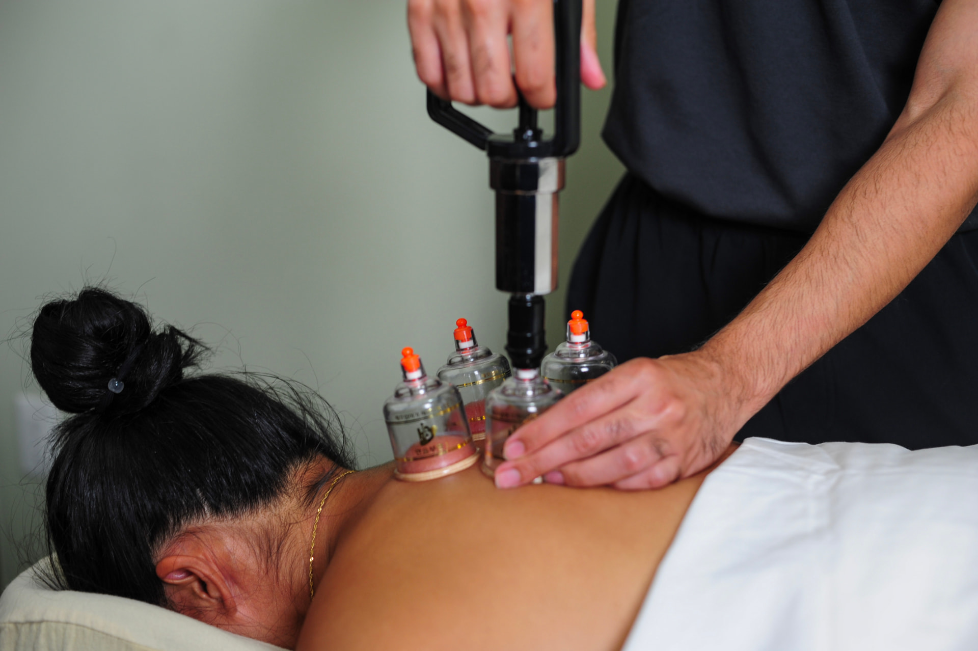 Cupping Treatment in Brampton